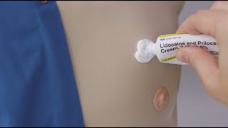 How to apply lidocaine cream to your port [upl. by Siwel]