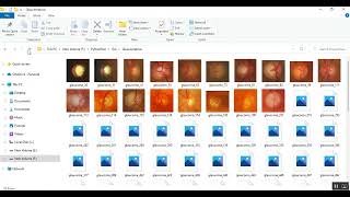 Glaucoma detection in fundus image using CNN [upl. by Einnep]