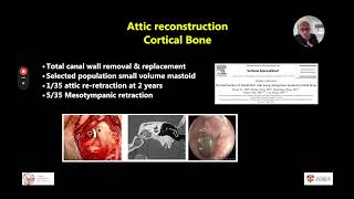 Cholesteatoma Recurrence in Adults Reconstruction vs ObliterationNirmal Patel [upl. by Nohj]