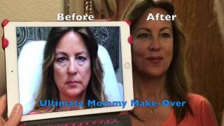 LIQUID FACELIFT  ULTIMATE Dermal Filler MAKEOVER [upl. by Hokanson]