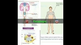 Paraplegia [upl. by Angel525]