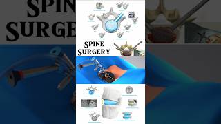 Spine Surgery with Duo™ Ti Expandable Interbody Fusion System from Spineology 3danimation short [upl. by Andryc]