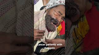 cancer maggots myiasis rare case of maggots live 10000 maggots eating cancer patients [upl. by Ative]