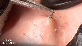 How Ingrown Hairs Are Removed  Art Insider [upl. by Anirbas]