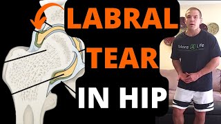 Labral Tear In Hip  Symptoms Treatment amp Exercises For Labral Tear In Hip [upl. by Ames210]