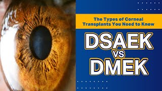 The Types of Corneal Transplants You Need to Know  DSAEK vs DMEK [upl. by Ahkeber]