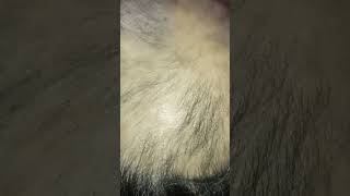 Severe alopecia Areata create situation complete hair loss treatment viralvideo alopecia haircar [upl. by Iverson]