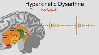 Hyperkinetic Dysarthria  samples and explanation [upl. by Laerdna230]