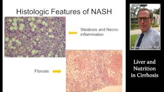 LIVER amp NUTRITION IN CIRRHOSIS by Dr Robert Gish [upl. by Timothy]