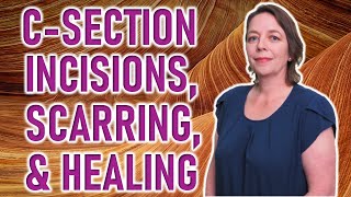 How to Care for Cesarean Section Scars and Incisions  C Section Scar Healing Recovery amp Treatment [upl. by Lacim]