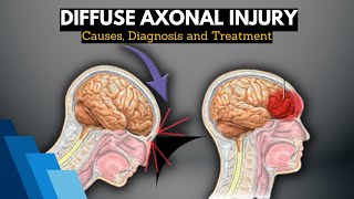 Diffuse Axonal Injury Causes Signs and Symptoms Diagnosis and Treatment [upl. by Morly]