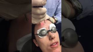 Erbium Yag Laser Treatment using Asclepion MCL31 Dermablate [upl. by Henn]