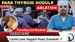 Para Thyroid Nodule ABLATION  LIVE CASE  Dr Arup Karmakar drarupkarmakar1492 [upl. by Ema793]