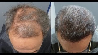 5602 Grafts HT by FUE Advanced alopecia Early regrowth at 5 months Injertocapilarcom16632016 [upl. by Lelah]