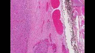 Histopathology ThyroidFollicular carcinoma [upl. by Tager567]