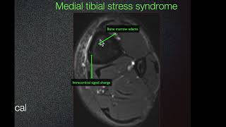 Sports Medicine Case 36 16yearold Soccer Player with Bilateral Exertional Leg pain [upl. by Ecraep]