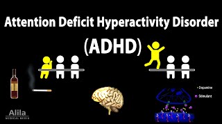 Attention Deficit Hyperactivity Disorder ADHD Animation [upl. by Som]