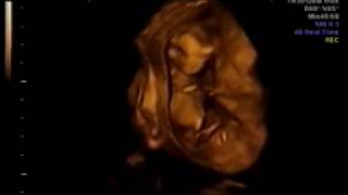 4D ultrasound 13 weeks [upl. by Oicanata226]