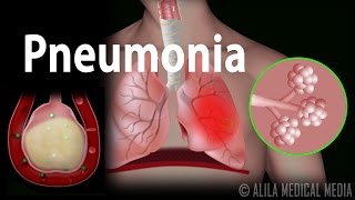 Pneumonia Animation [upl. by Raffaello]