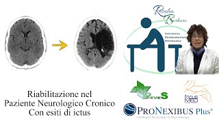 Ipertono e spasticità post ictus quali approcci o terapie Dressa Ft Barbaro Rosalia [upl. by Natfa]