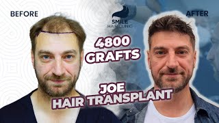 Turning Back the Clock Incredible Results of a 4800 Graft Hair Transplant  Before and After [upl. by Nrubua]