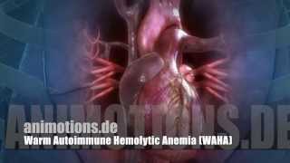 WAHA Warm Autoimmune Hemolytic Anemia AIHA [upl. by Hurlow]