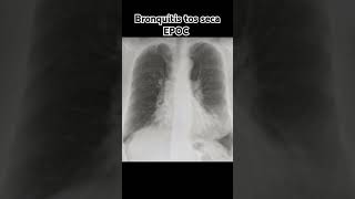 BRONQUITIS TOS SECA EPOC [upl. by Shiff]