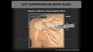 Left Suprascapular Nerve Block [upl. by Nitaf]