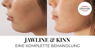 JAWLINE amp KINN  Fliehendes Kinn unterspritzen  Jawline Contouring  LIPFACTORY [upl. by Werdnaed811]