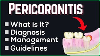 PERICORONITIS  Diagnosis amp Management with guidelines [upl. by Dorelle499]