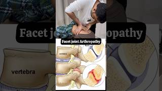 Facet joint arthropathy treatment feed ytshort trend [upl. by Stoneham]