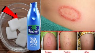 पुराने दाद खाज खुजली की 2 दिन में छुट्टी कर देगा  Fungal infection treatment [upl. by Carina]