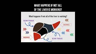 What happens if not all of the liver is working liver liverhealth livercirrhosis health [upl. by Refinaj]