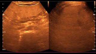 Fatty Liver  Diffuse hepatic steatosis  Liver Ultrasonogram [upl. by Nuahsal]