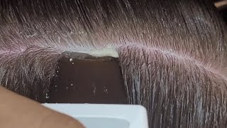 Combing And Scratching Dandruff Off Scalp 1174 [upl. by Akinam]