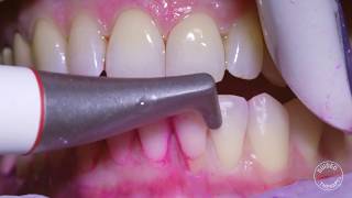 How teeth should be cleaned at the Dentist  Hygienist [upl. by Elisabet]