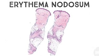 Erythema nodosum panniculitis subcutaneous nodules fat necrosis dermatology pathology dermpath [upl. by Blatman]