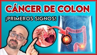 ASÍ empieza el CÁNCER DE COLON  ¡SIGNOS de ADVERTENCIA [upl. by Branen]