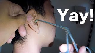 Something HUGE Stuck in Mans Ear for Weeks Finally Removed  What is It [upl. by Heger70]