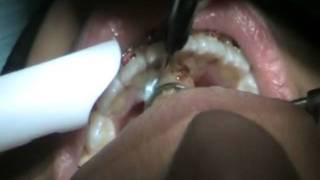 ORAL TUMOR EXCISION BY DIODE LASER WITHOUT ANESTHESIA DR MANAF TAHER AGHA [upl. by Assyral285]