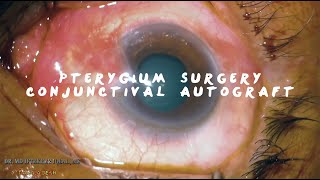 MIIQ 97 Pterygium Surgery Conjunctival Autograft with Sutures  DR MD IFTEKHER IQBAL RAJU [upl. by Nahtaneoj]