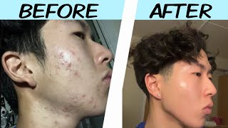 My Acne Journey Skincare Motivation [upl. by Hasty807]