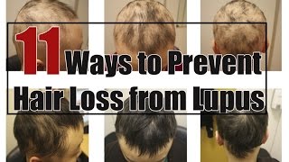 Prevent Hair Loss  11 Ways to Prevent Hair Loss from Lupus [upl. by Dnalyag]