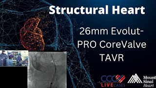 26mm EvolutPRO CoreValve TAVR  March 13 2018 [upl. by Romelle]