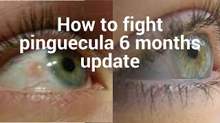 How to fight pinguecula update for 6 months [upl. by Delila751]