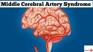 Middle Cerebral Artery SyndromeMiddle Cerebral Artery StrokeZeenad Learning Hub [upl. by Lahcear]