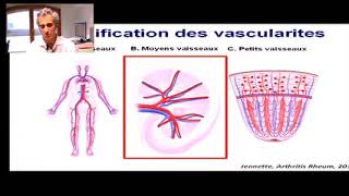 Web conférence sur les vascularites systémiques [upl. by Ilenna979]