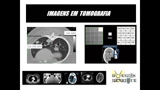 ESCALA DE HOUNSFIELD  HU  E FORMAÇÃO DA IMAGENS EM TOMOGRAFIA [upl. by Morten]