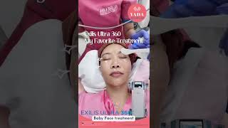 Exilis Ultra 360 for tightening your face  Yada Clinic Pattaya [upl. by Ahsienot]