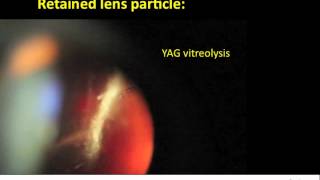 YAG vitreolysis for retained lens particle after cataract surgery [upl. by Annavahs]